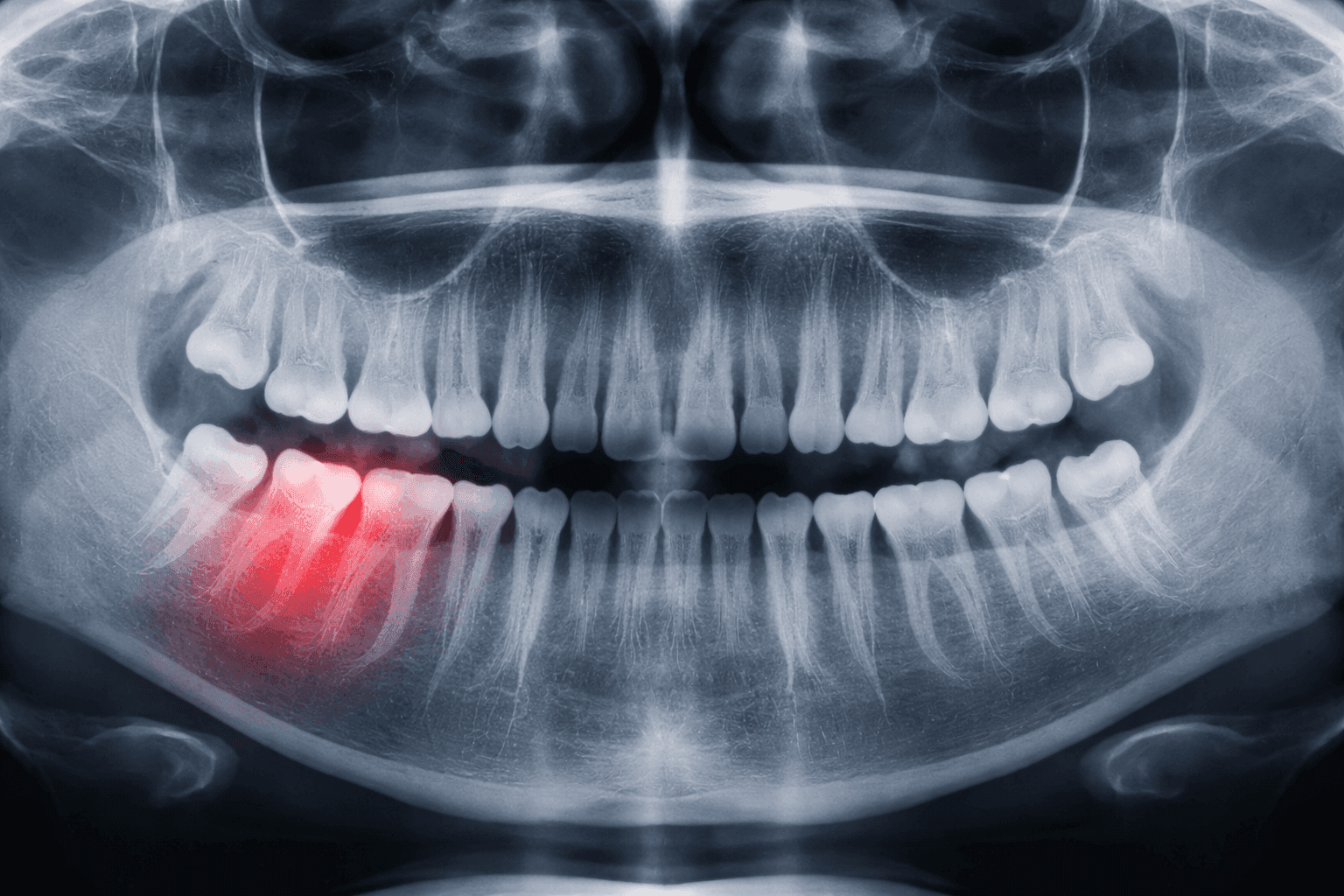 Перелом корня зуба