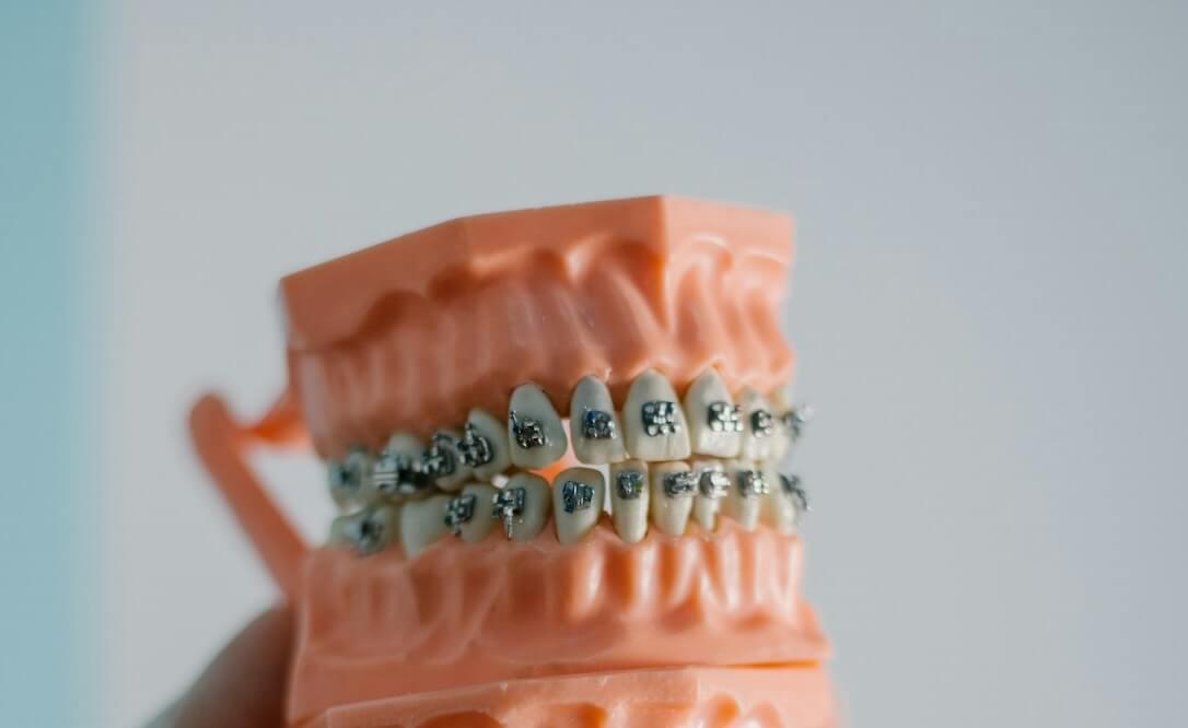 Виды металлических брекетов