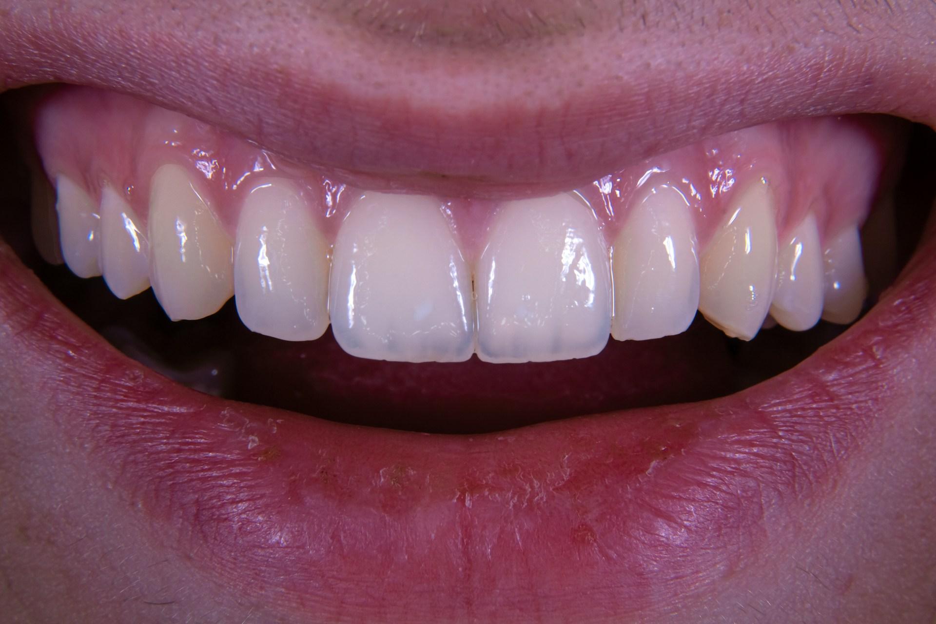 Болят верхние зубы: что делать