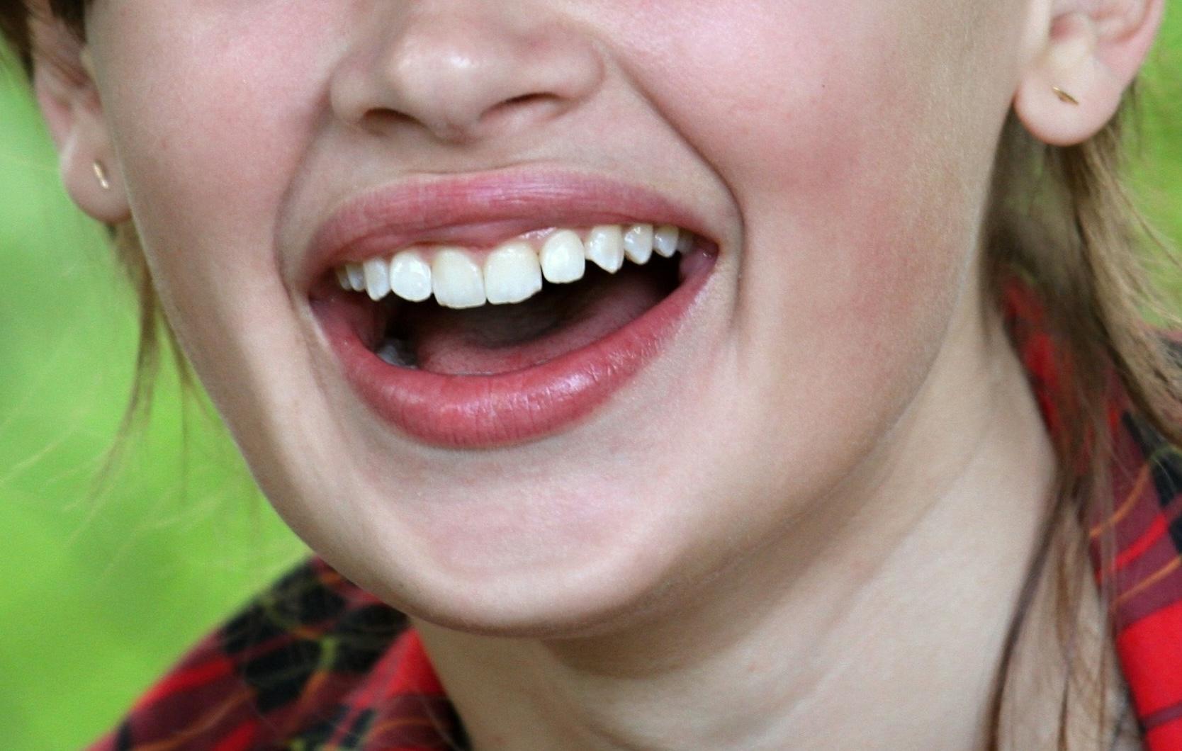 Брекеты для детей 13 лет