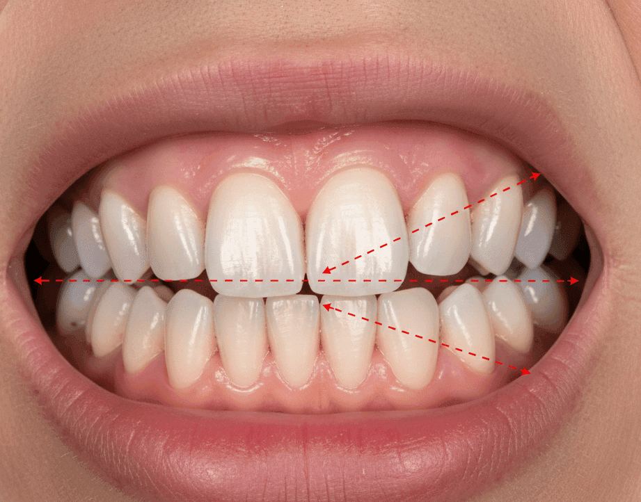 Поднятие высоты прикуса