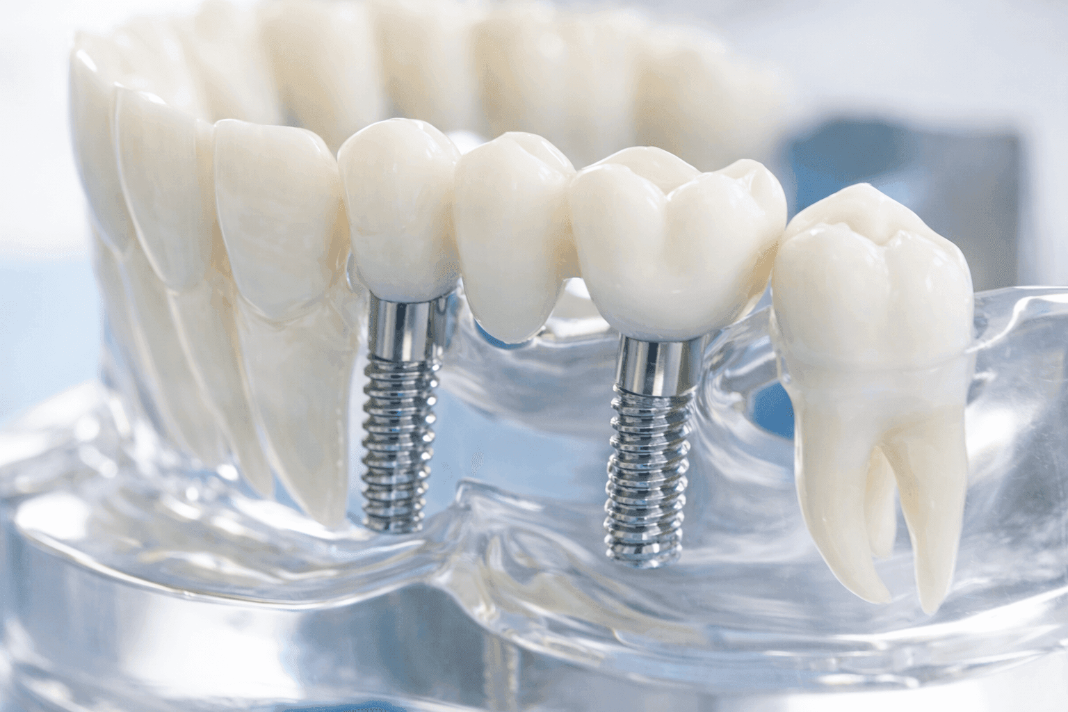 Слетела коронка с импланта: что делать?