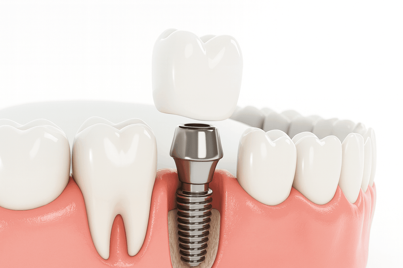 Виды имплантации зубов