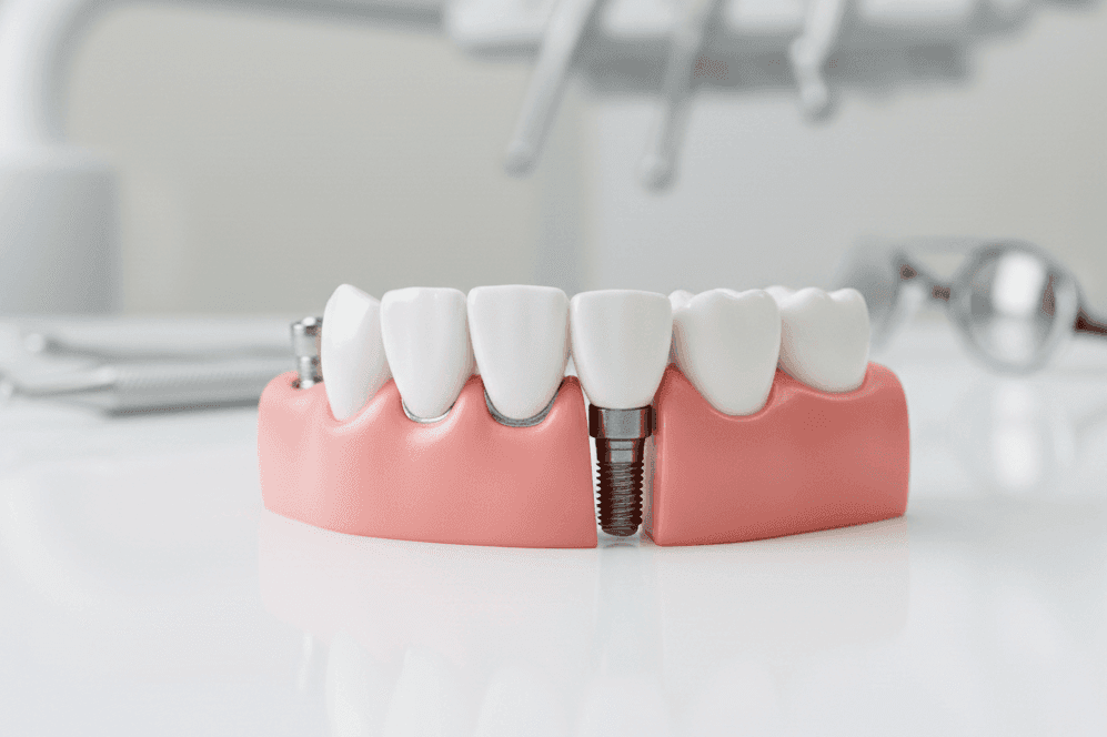 Виды протезирования зубов - какие лучше и почему?