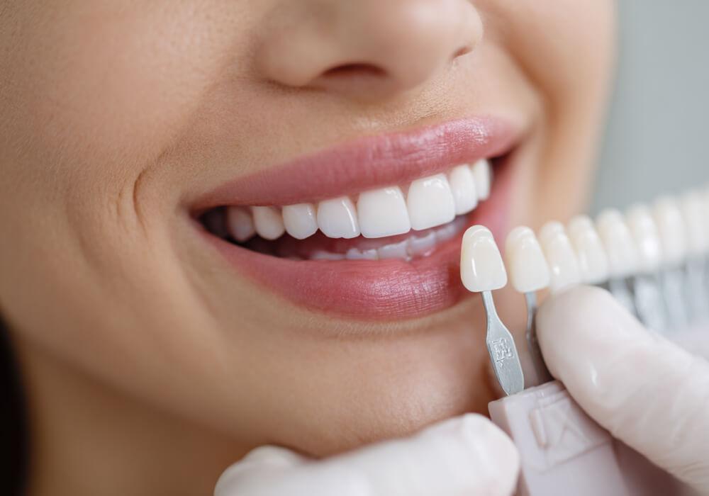 Керамические виниры для зубов