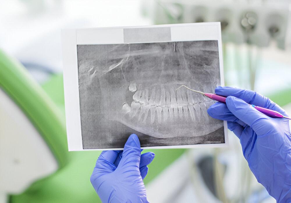 Чем отличается панорамный снимок зубов от КТ?