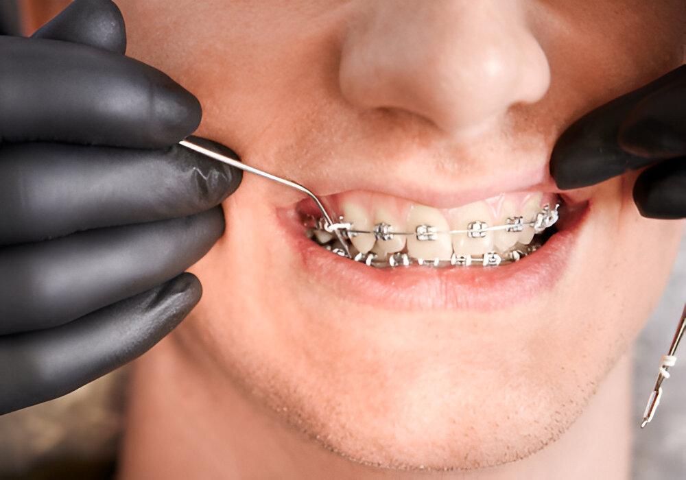Почему не смыкаются зубы после установки брекетов?