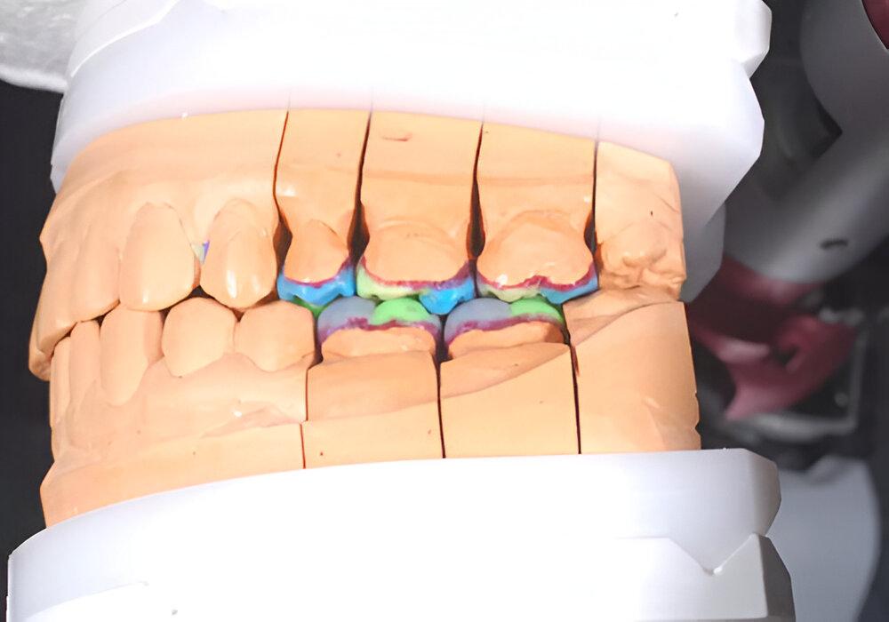 Реставрационная керамическая вкладка для поднятия прикуса