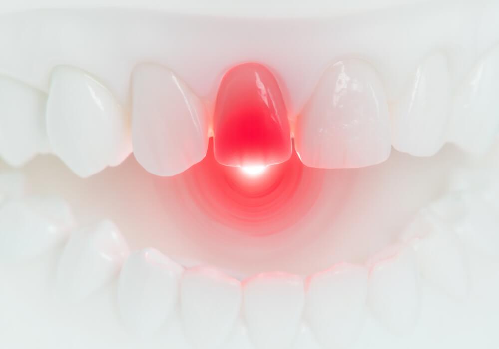 Пульсирующая боль в зубе: причины и лечение