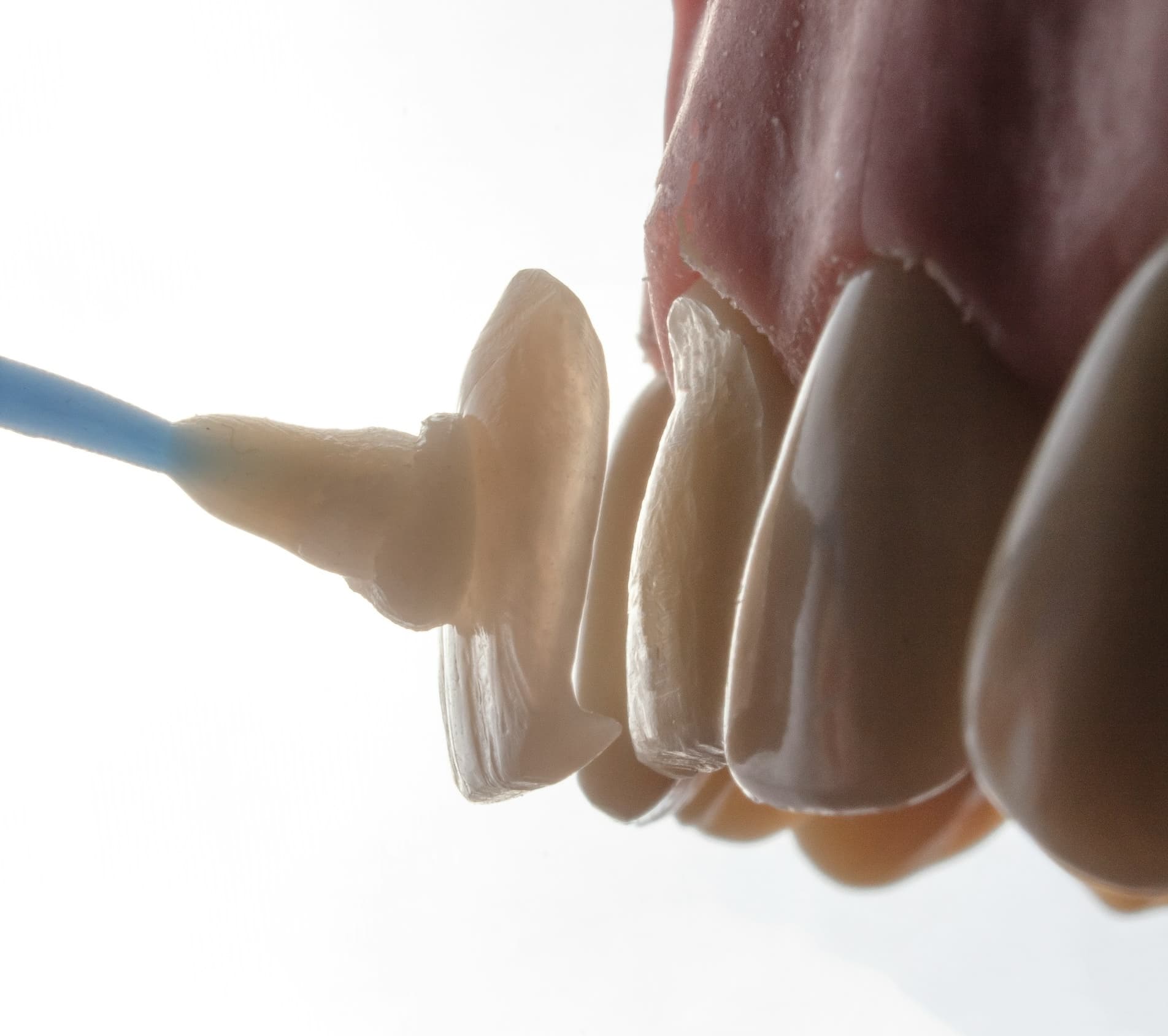 Как устанавливают виниры на зубы?