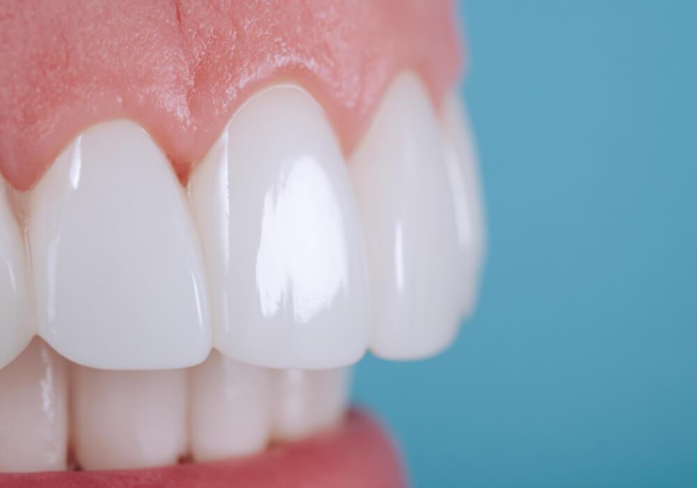 Срок службы виниров