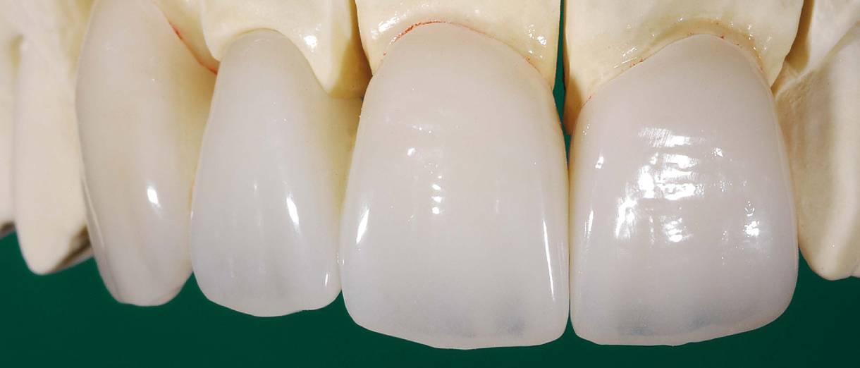 Протезирование передних зубов верхней и нижней челюсти