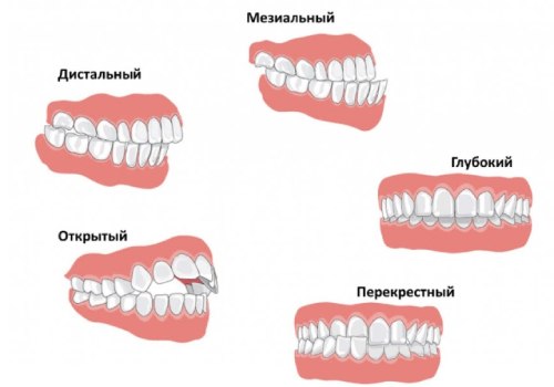 Лечение пульпита по низкой цене - стоматологическая клиника д. Семениченко