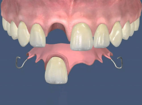 Временные протезы зубов