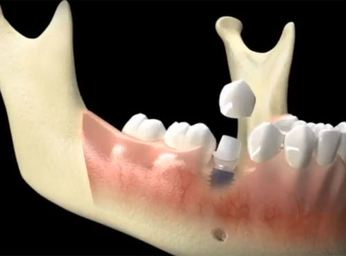 Несъемный протез на 1 зуб