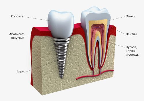 Что такое абатмент в стоматологии
