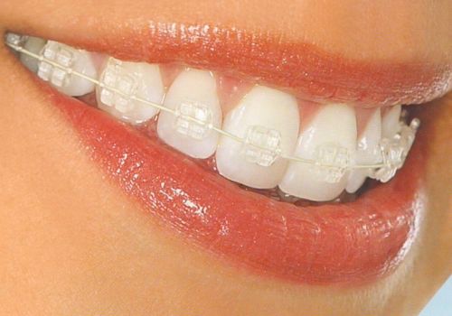 Белые брекеты на зубы