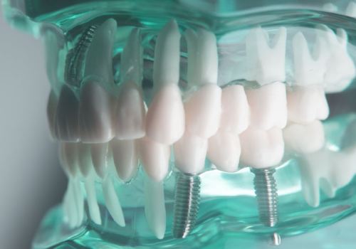 Импланты зубов Biohorizons