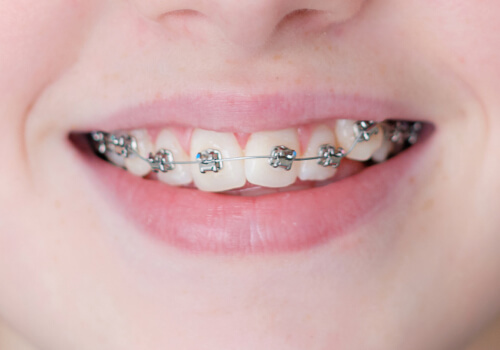 Брекет-системы на верхние зубы