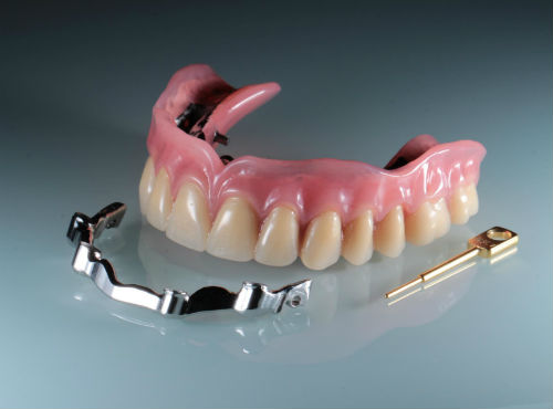 Бюгельные протезы для зубов на замках