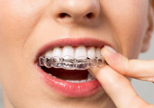 Что такое элайнеры для зубов