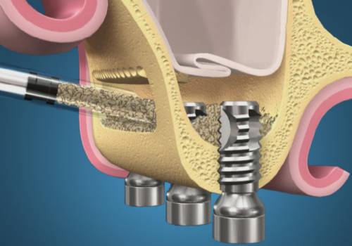 Синус лифтинг при имплантации зубов