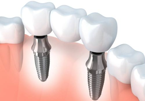 Импланты зубов Dentium