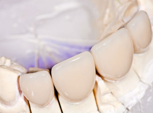 Фарфоровые протезы зубов