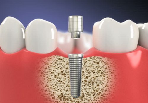 Формирование десны при имплантации зубов