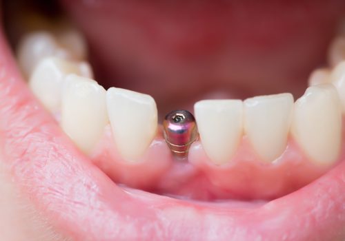 Имплант на передний зуб