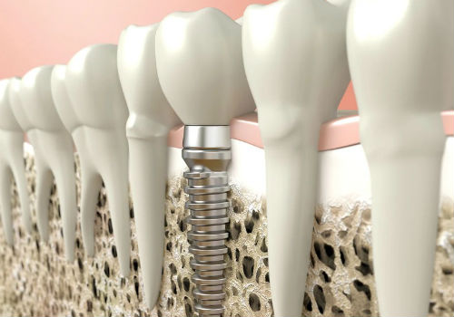 Дентальная имплантация зубов