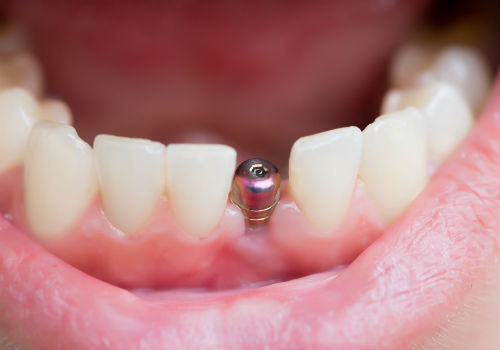 Имплантация нижнего зуба