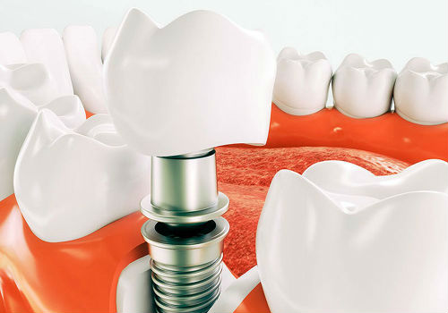 Имплантация зубов под ключ