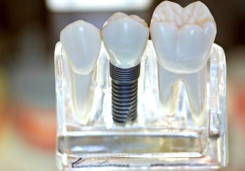 Этапы и сроки имплантации зубов