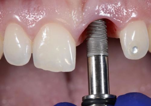 Импланты зубов Impro