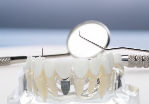 История имплантации зубов