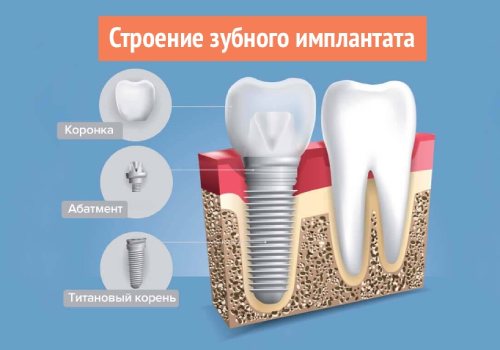 Из чего состоит имплант зуба