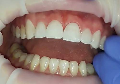 Израильские зубные импланты