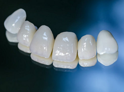 Керамические протезы зубов
