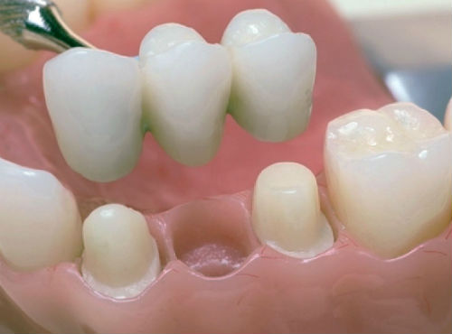 Консольные протезы зубов
