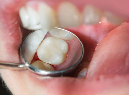 Лечение скола зуба