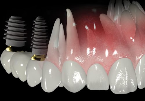 most ili implant na zhevatelnyj zub