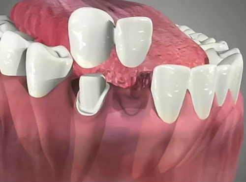 Мостовидный протез на два зуба