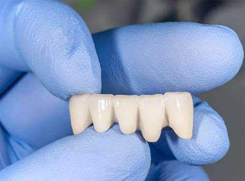 Мостовидные протезы на передние зубы