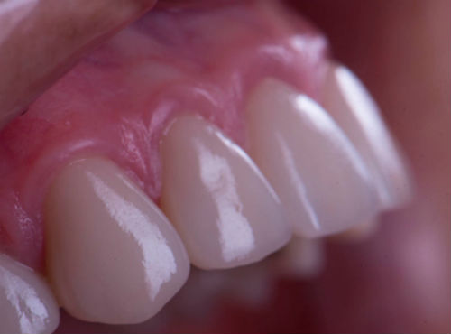 Зубной мост на передние зубы