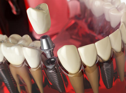 Одномоментное протезирование зубов