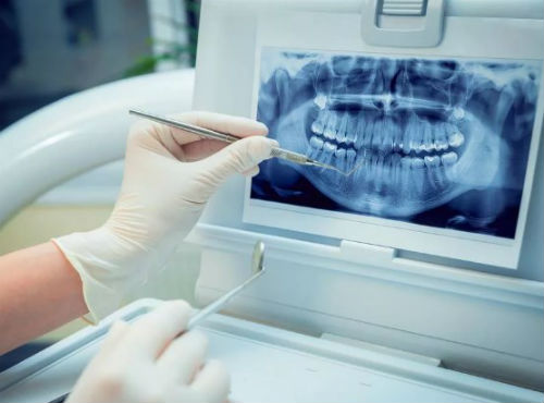 Панорамный рентген зубов (ОПТГ)
