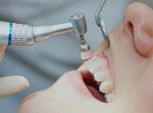 Пародонтологическая чистка зубов