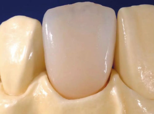 Пластиковые протезы зубов