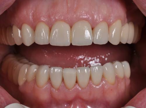 Протез несъемный на 4 передних зуба